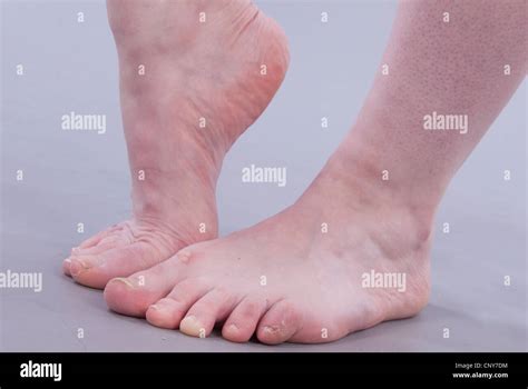 gross feet pictures|375 Images Of Ugly Feet Stock Photos & High